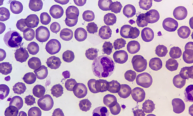 Canine Distemper Blood Smear